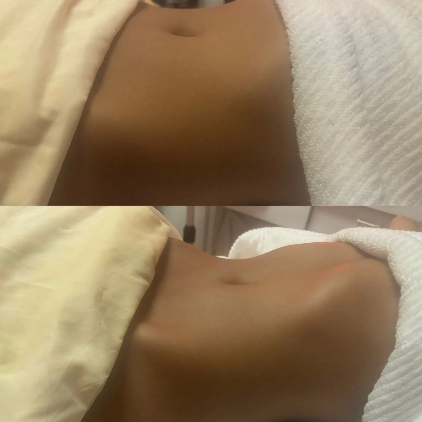 After image for Brazilian Sculpting Lymphatic Massage, showing the client’s abdomen after treatment.