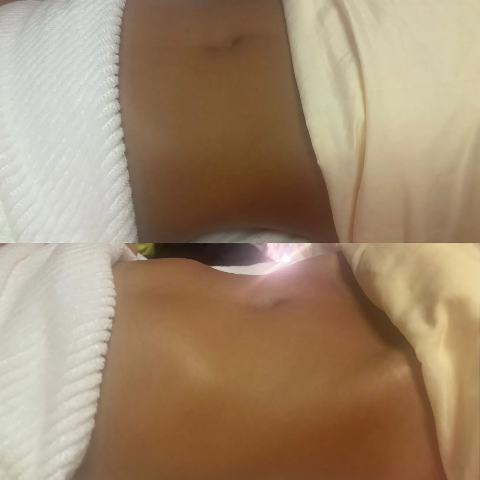 Before image for Brazilian Sculpting Lymphatic Massage, showing the client’s abdomen before treatment.